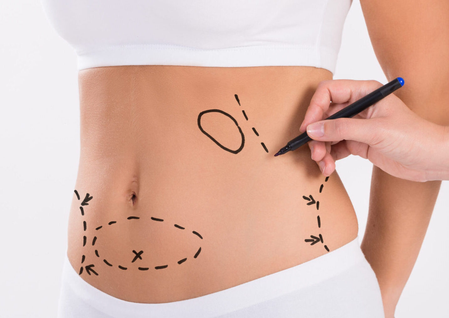 Liposuction (Fat Removal) Surgery at Silkor