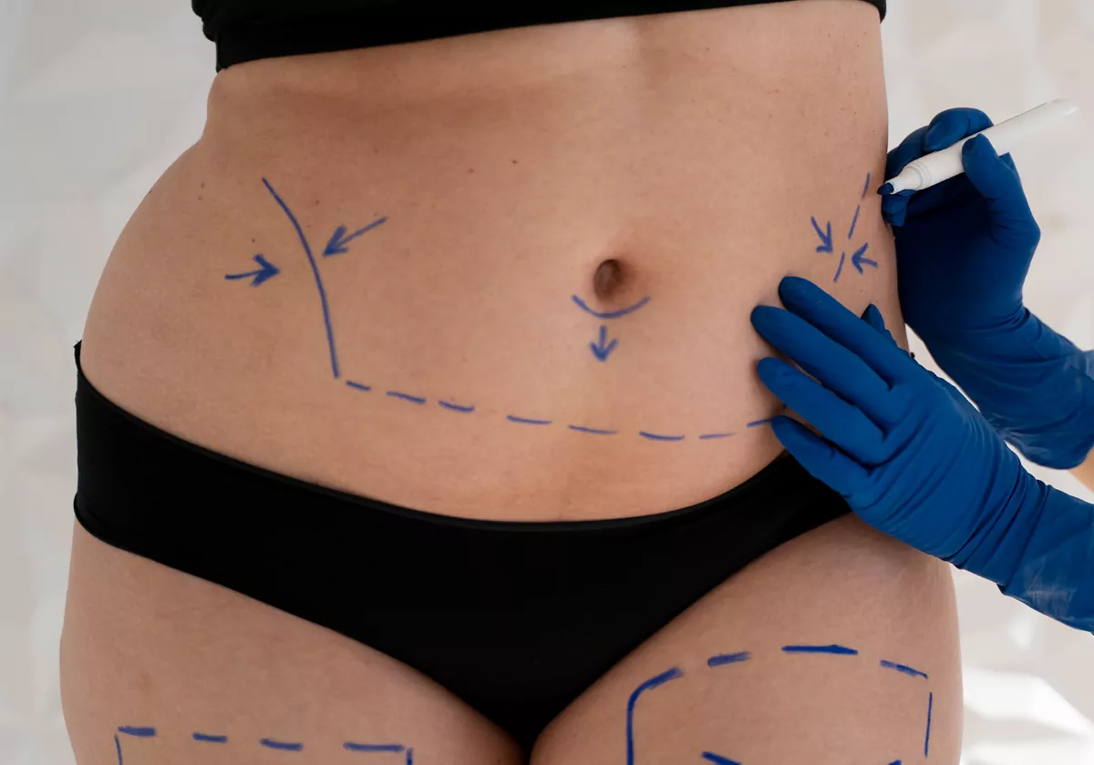 Liposuction: Your Guide to Body Contouring